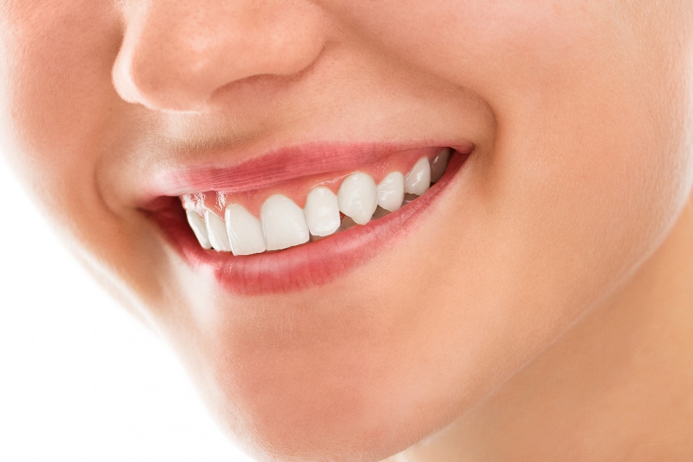 Blanqueamiento dental en Clinica Dental Yolanda Pañeda