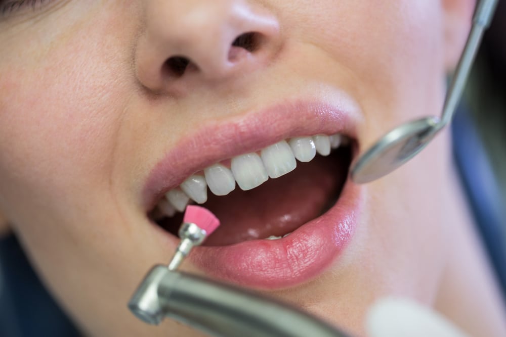 Blanqueamiento e higiene dental en Gijon